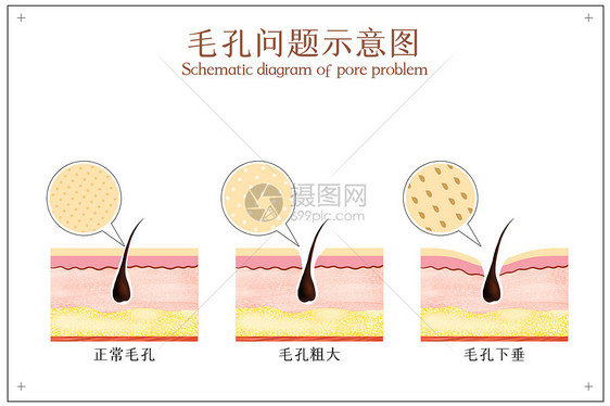 面部毛孔问题示意图图片