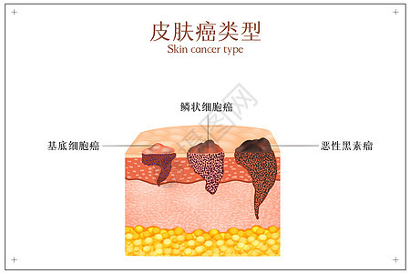 皮肤癌症类型示意图图片