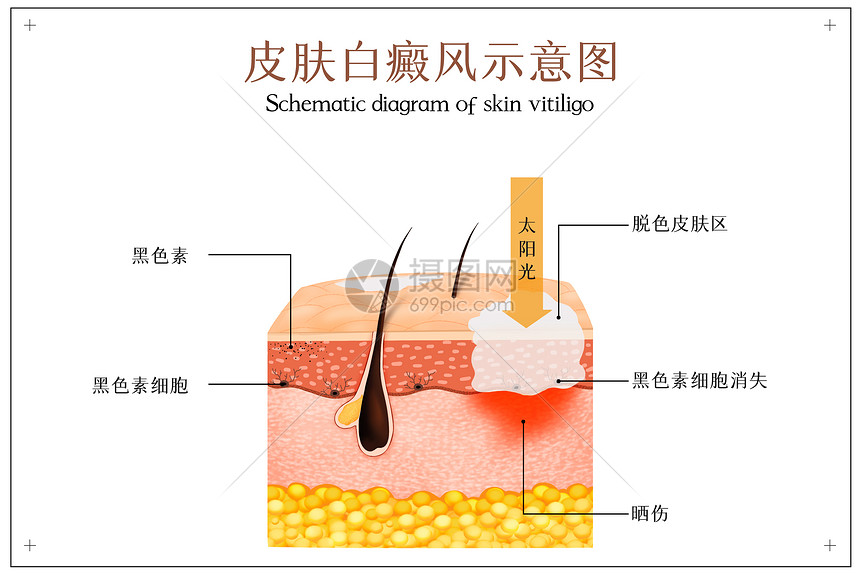 皮肤白癜风示意图图片