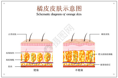 橘皮皮肤示意图高清图片