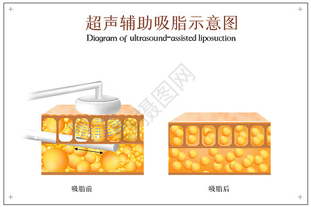 超声辅助吸脂示意图图片