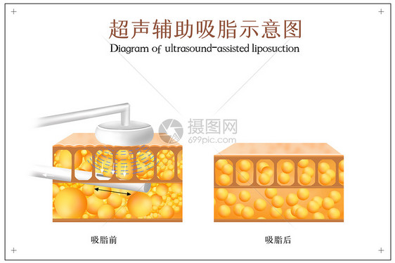 超声辅助吸脂示意图图片