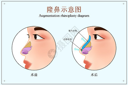 隆鼻示意图背景图片