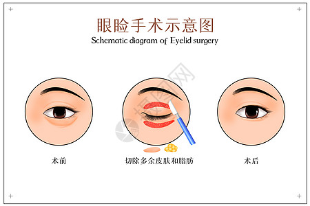 眼睑手术示意图图片