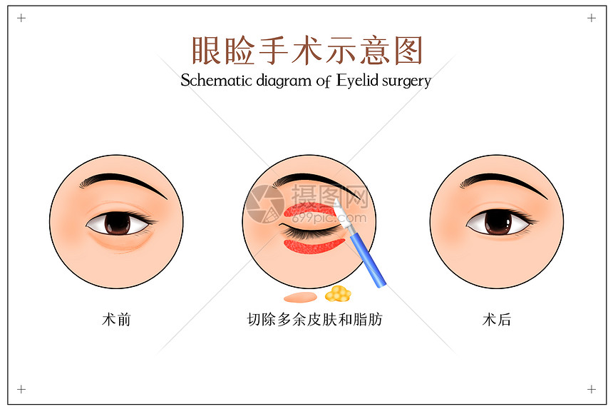 眼睑手术示意图图片