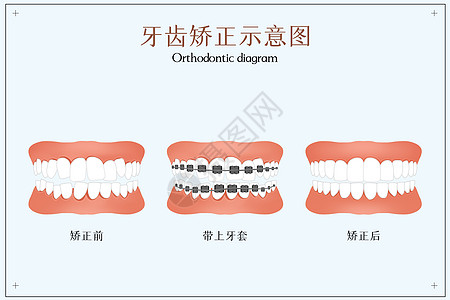 带牙套牙齿矫正示意图插画