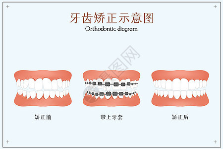 牙齿矫正示意图图片