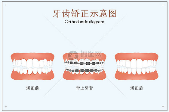 牙齿矫正示意图图片