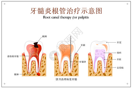 牙髓炎根管治疗示意图图片