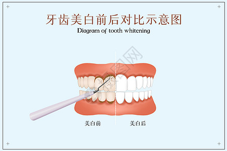 牙齿对比牙齿美白前后对比示意图插画