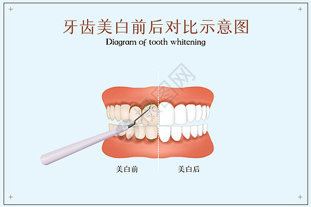 牙齿美白前后对比示意图背景图片