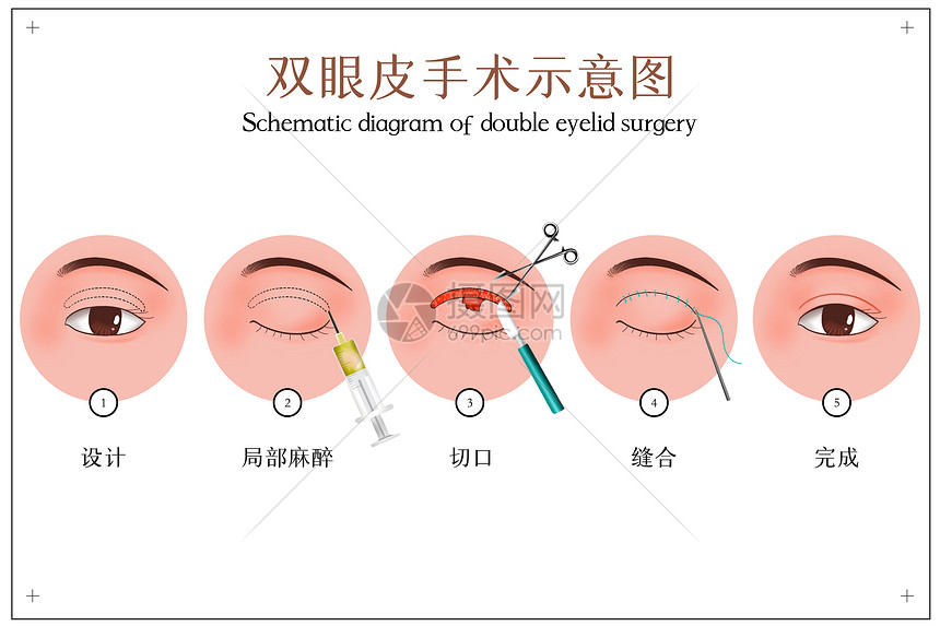 双眼皮手术示意图