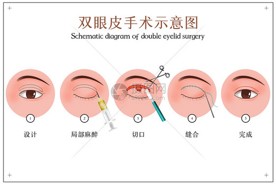 双眼皮手术示意图图片