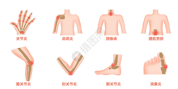 人体关节炎部位医疗插画背景图片