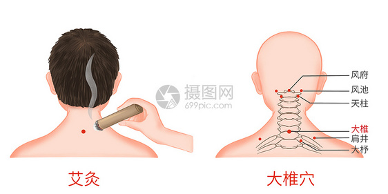 颈椎病大椎穴艾灸医疗插画图片