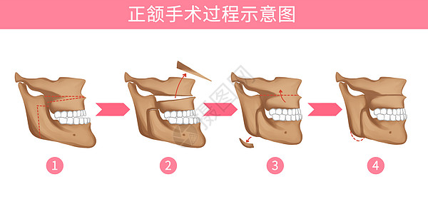 口腔正颌手术过程医疗插画高清图片