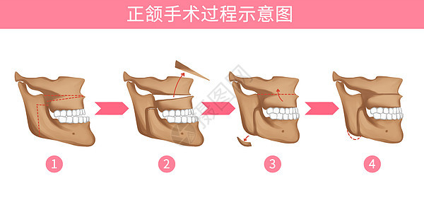 口腔正颌手术过程医疗插画图片