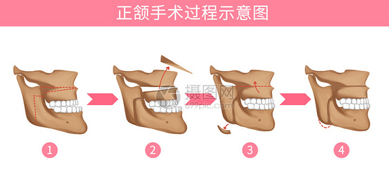 口腔正颌手术过程医疗插画图片