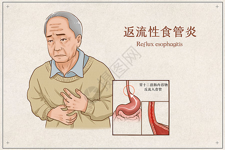 反流性食管炎医疗插画图片