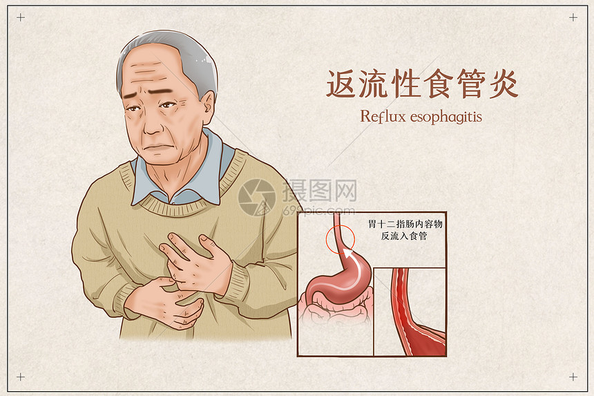 反流性食管炎医疗插画图片