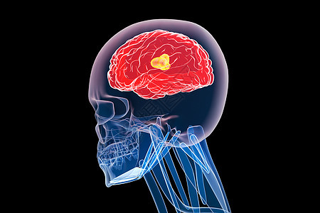 C4D脑部疾病图片