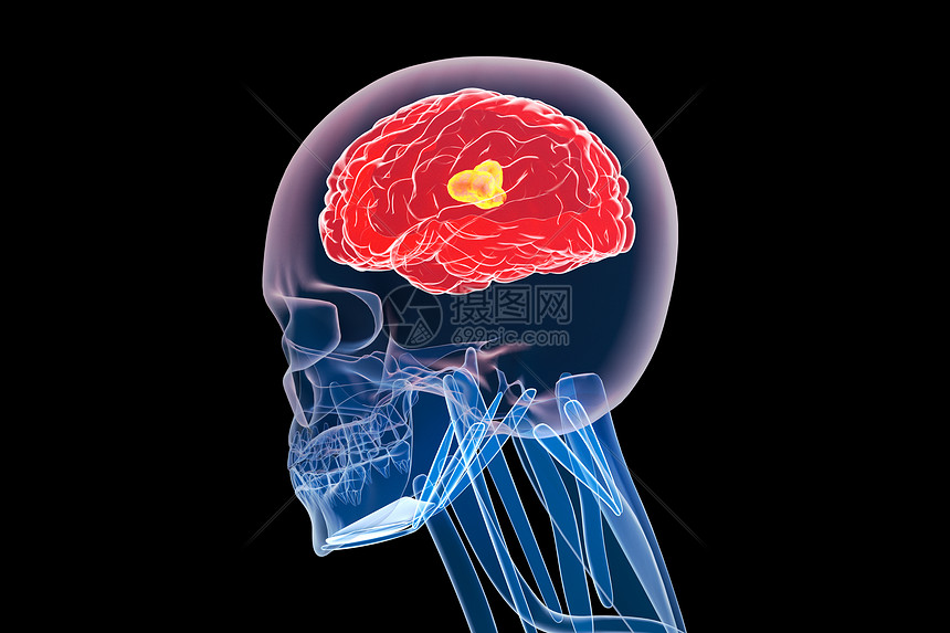 C4D脑部疾病图片
