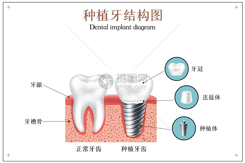 种植牙结构示意图图片