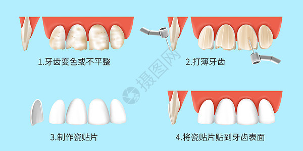 瓷贴面的治疗过程医疗插画图片