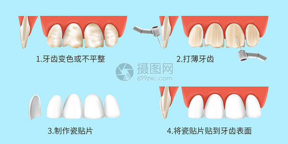 瓷贴面的治疗过程医疗插画图片