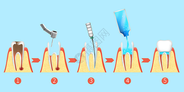 牙齿根管治疗步骤医疗插画背景图片