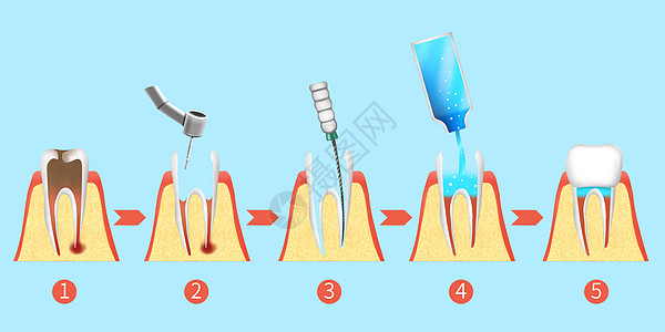 牙齿根管治疗步骤医疗插画插画