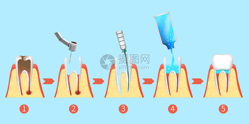 牙齿根管治疗步骤医疗插画图片