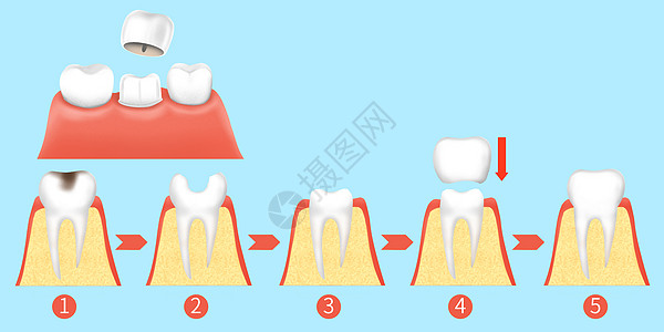 牙齿烤瓷牙治疗步骤医疗插画高清图片