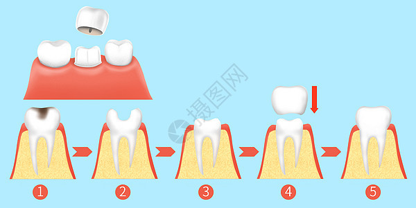 牙齿烤瓷牙治疗步骤医疗插画图片