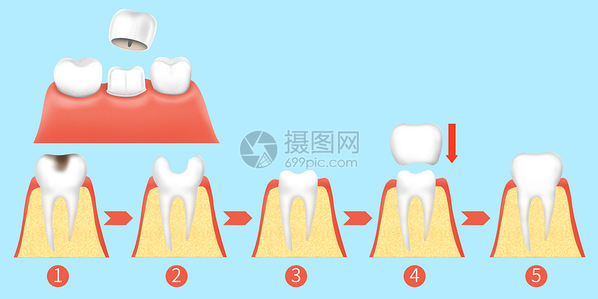 牙齿烤瓷牙治疗步骤医疗插画图片