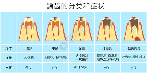 龋齿的分类和症状科普医疗插画图片