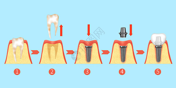 牙齿种植牙治疗过程步骤医疗插画背景图片