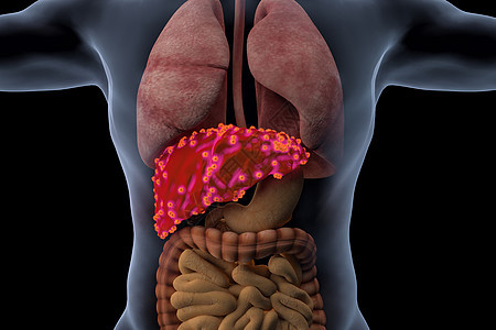人体肝脏病变背景图片