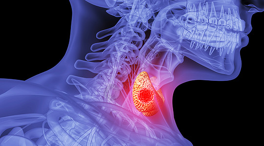 肿大人体甲亢场景设计图片