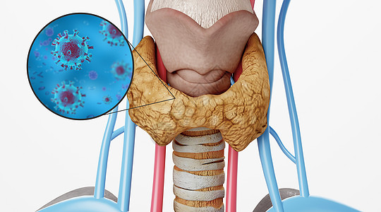 肿大人体甲亢场景设计图片