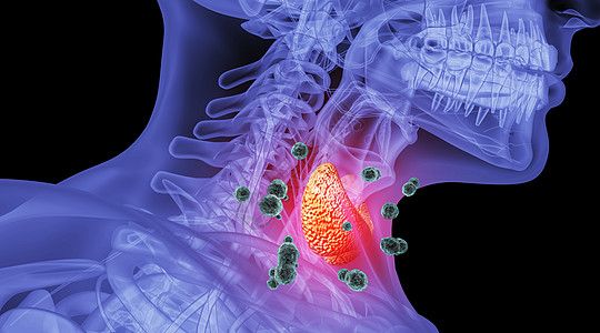 喉咙人体甲亢场景设计图片