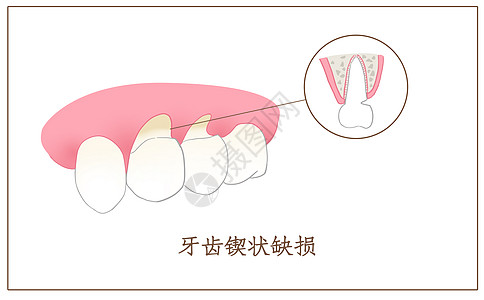 牙齿锲状缺损口腔医学配图图片