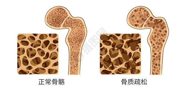 整形对比正常骨质和骨质疏松对比医疗插画插画