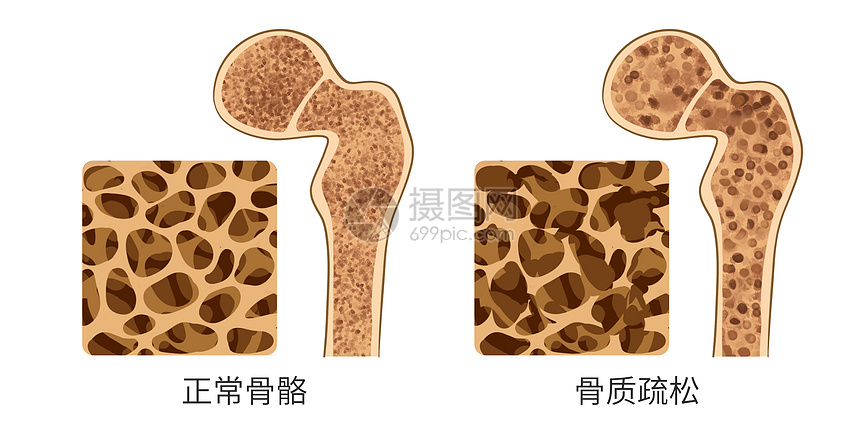 正常骨质和骨质疏松对比医疗插画插画图片下载 正版图片 摄图网 正常骨质和骨质疏松对比医疗插画插画图片下载 正版图片 摄图网