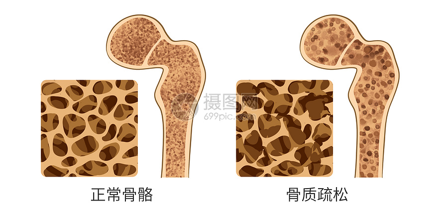 正常骨质和骨质疏松对比医疗插画图片