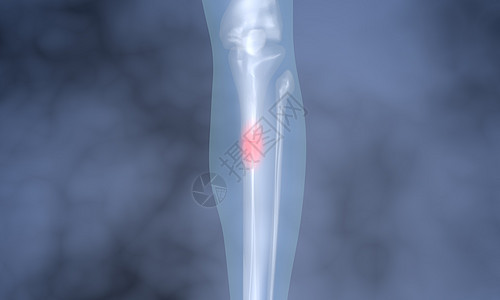 腿骨骨折背景图片