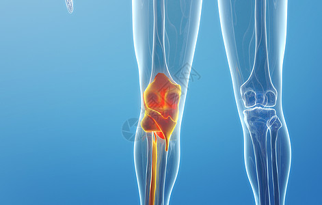 膝关节关节炎症高清图片