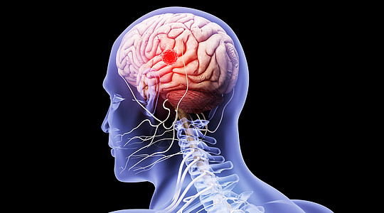 癌图片_癌素材_癌高清图片_摄图网图片下载