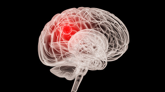 癌图片_癌素材_癌高清图片_摄图网图片下载
