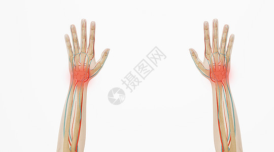 腕管症3D腱鞘炎场景设计图片